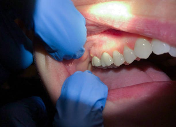 Best Chipped Tooth Repair Near Me  in Miami Springs, FL